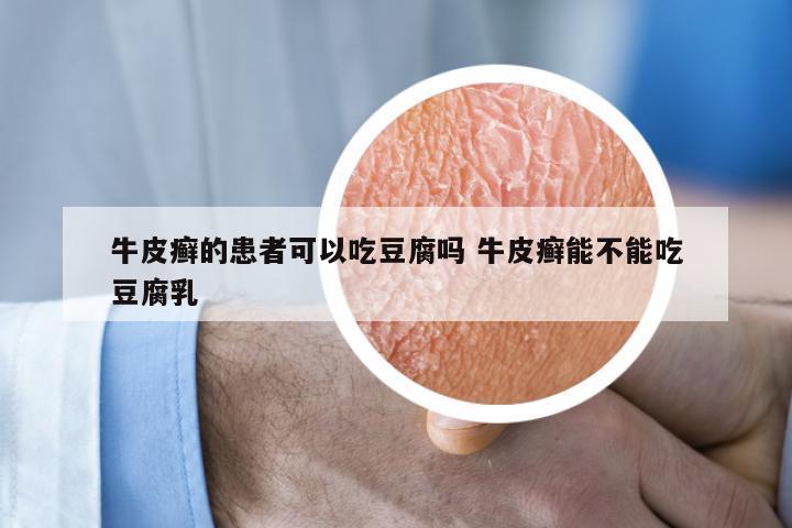 牛皮癣的患者可以吃豆腐吗 牛皮癣能不能吃豆腐乳