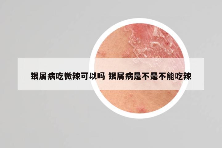 银屑病吃微辣可以吗 银屑病是不是不能吃辣