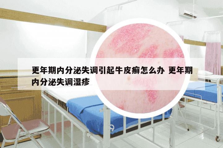 更年期内分泌失调引起牛皮癣怎么办 更年期内分泌失调湿疹