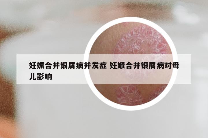 妊娠合并银屑病并发症 妊娠合并银屑病对母儿影响