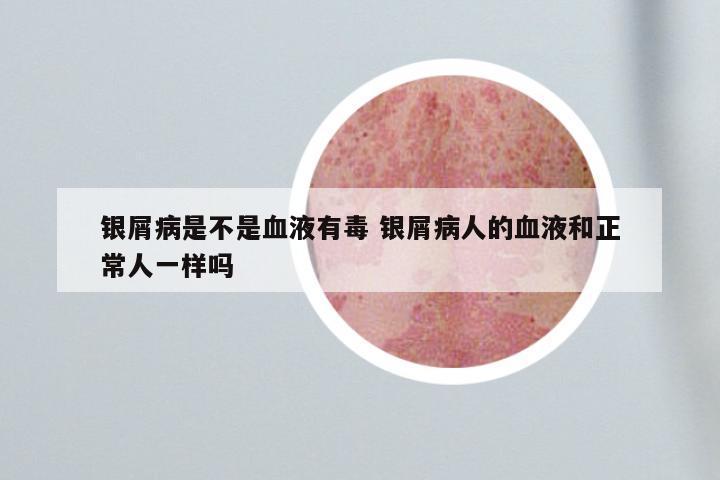 银屑病是不是血液有毒 银屑病人的血液和正常人一样吗