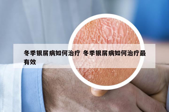 冬季银屑病如何治疗 冬季银屑病如何治疗最有效