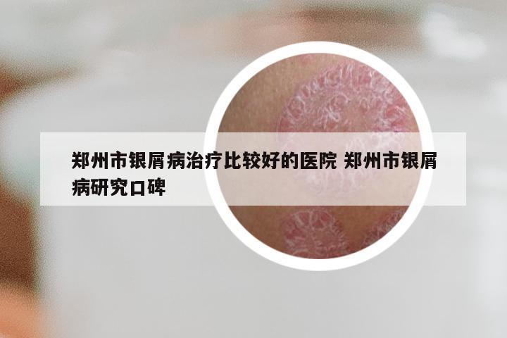 郑州市银屑病治疗比较好的医院 郑州市银屑病研究口碑