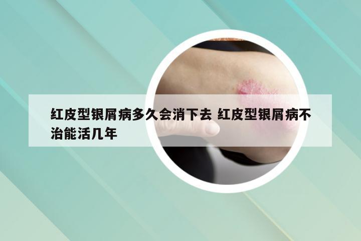 红皮型银屑病多久会消下去 红皮型银屑病不治能活几年