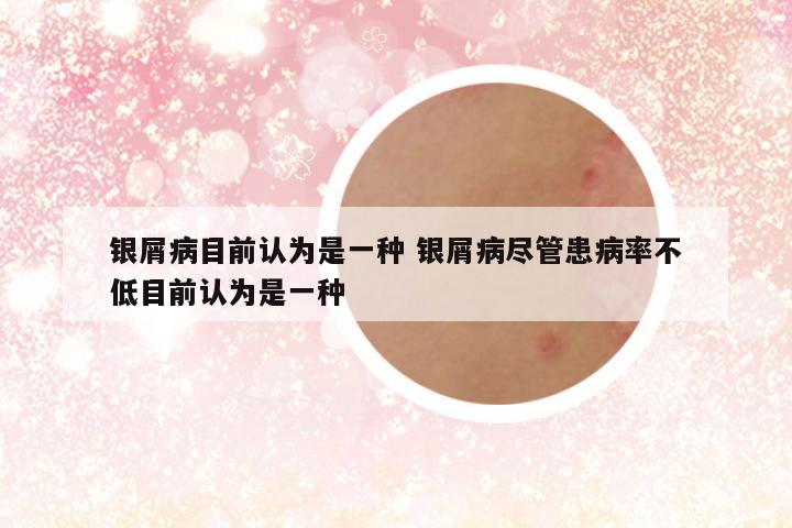 银屑病目前认为是一种 银屑病尽管患病率不低目前认为是一种