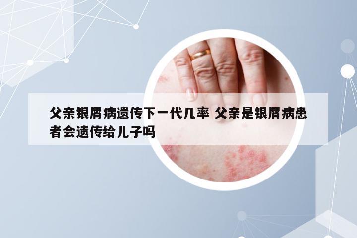 父亲银屑病遗传下一代几率 父亲是银屑病患者会遗传给儿子吗