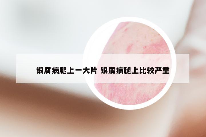 银屑病腿上一大片 银屑病腿上比较严重
