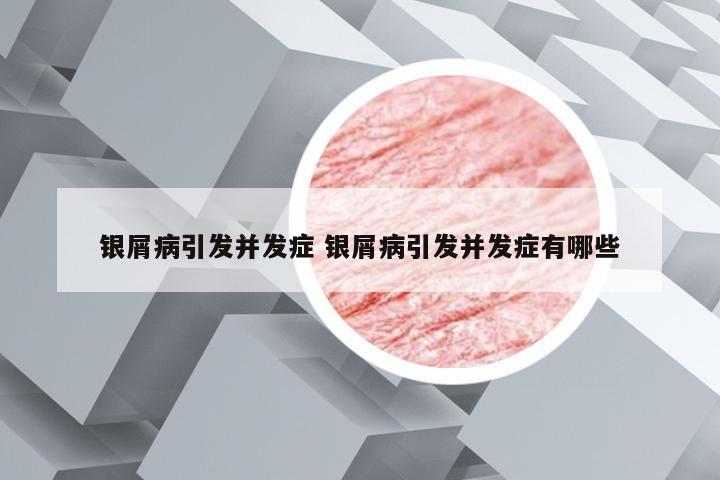 银屑病引发并发症 银屑病引发并发症有哪些