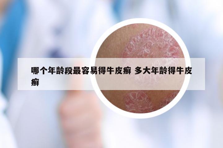 哪个年龄段最容易得牛皮癣 多大年龄得牛皮癣