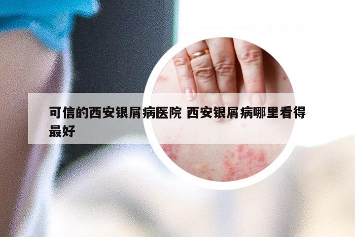 可信的西安银屑病医院 西安银屑病哪里看得最好