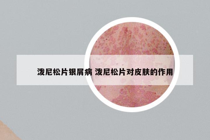 泼尼松片银屑病 泼尼松片对皮肤的作用