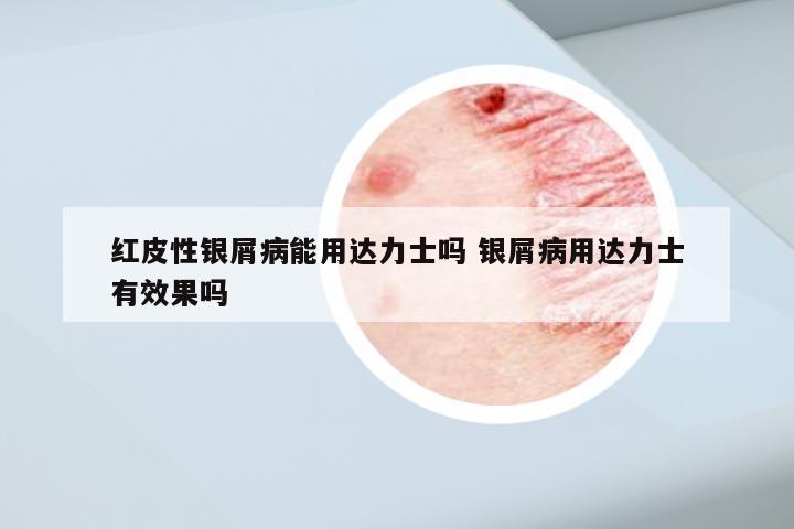 红皮性银屑病能用达力士吗 银屑病用达力士有效果吗