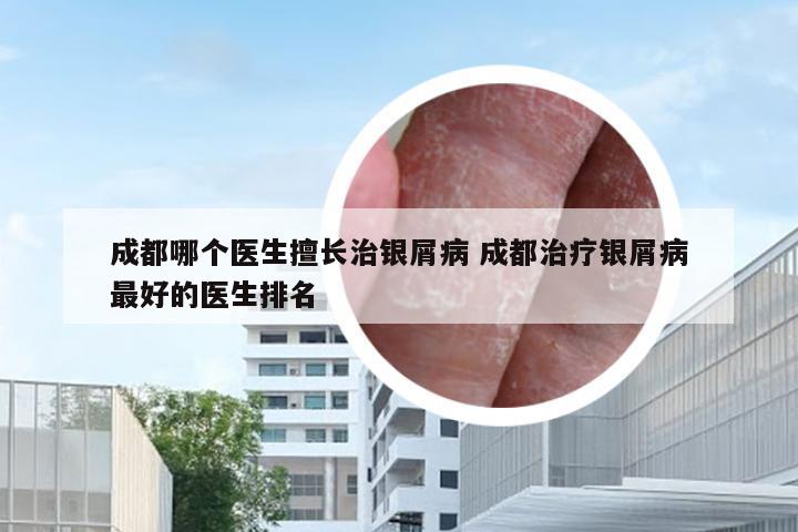 成都哪个医生擅长治银屑病 成都治疗银屑病最好的医生排名