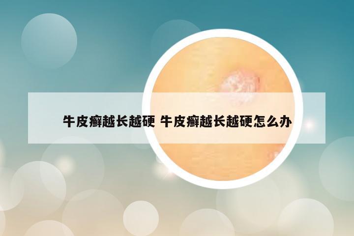 牛皮癣越长越硬 牛皮癣越长越硬怎么办
