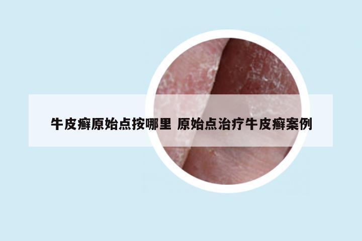 牛皮癣原始点按哪里 原始点治疗牛皮癣案例