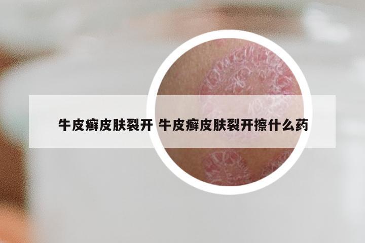 牛皮癣皮肤裂开 牛皮癣皮肤裂开擦什么药