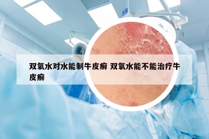 双氧水对水能制牛皮癣 双氧水能不能治疗牛皮癣