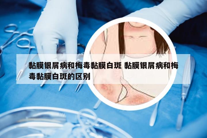 黏膜银屑病和梅毒黏膜白斑 黏膜银屑病和梅毒黏膜白斑的区别