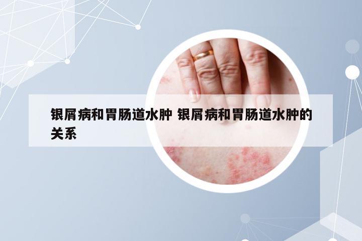 银屑病和胃肠道水肿 银屑病和胃肠道水肿的关系