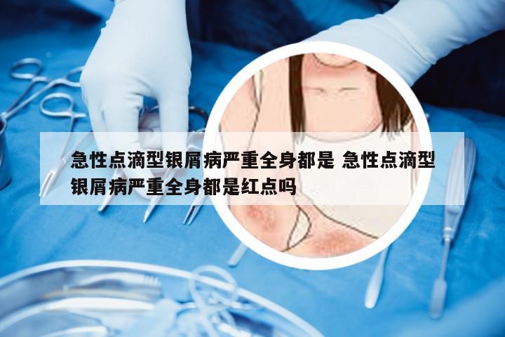 急性点滴型银屑病严重全身都是 急性点滴型银屑病严重全身都是红点吗