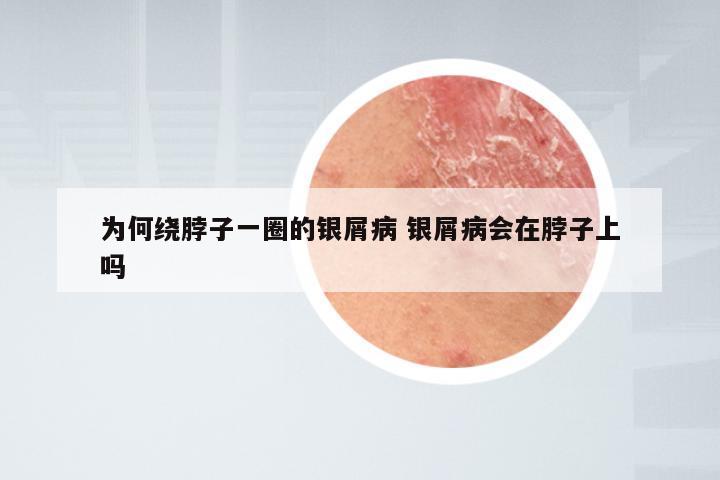 为何绕脖子一圈的银屑病 银屑病会在脖子上吗