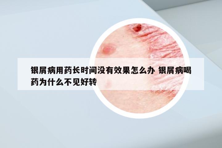 银屑病用药长时间没有效果怎么办 银屑病喝药为什么不见好转