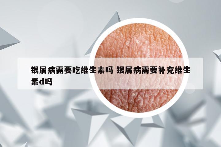 银屑病需要吃维生素吗 银屑病需要补充维生素d吗