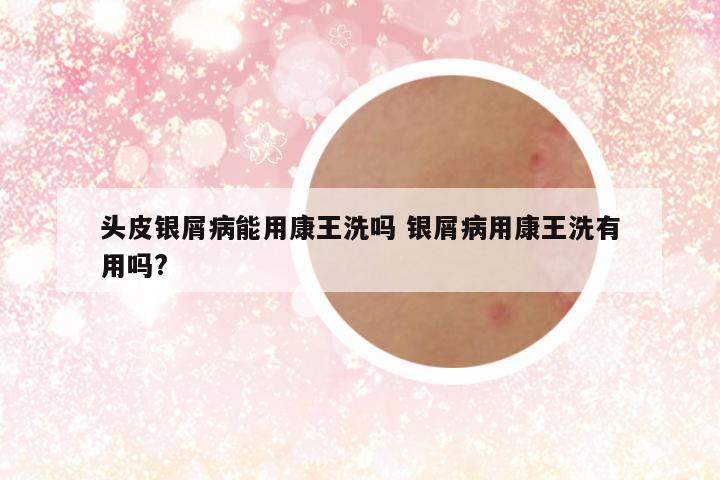 头皮银屑病能用康王洗吗 银屑病用康王洗有用吗?