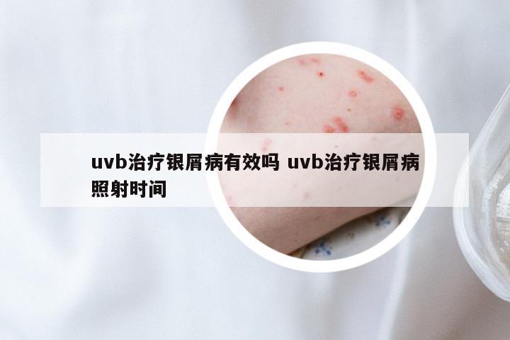 uvb治疗银屑病有效吗 uvb治疗银屑病照射时间