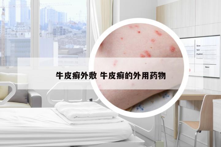 牛皮癣外敷 牛皮癣的外用药物