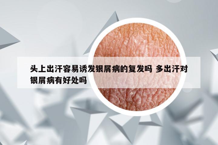 头上出汗容易诱发银屑病的复发吗 多出汗对银屑病有好处吗