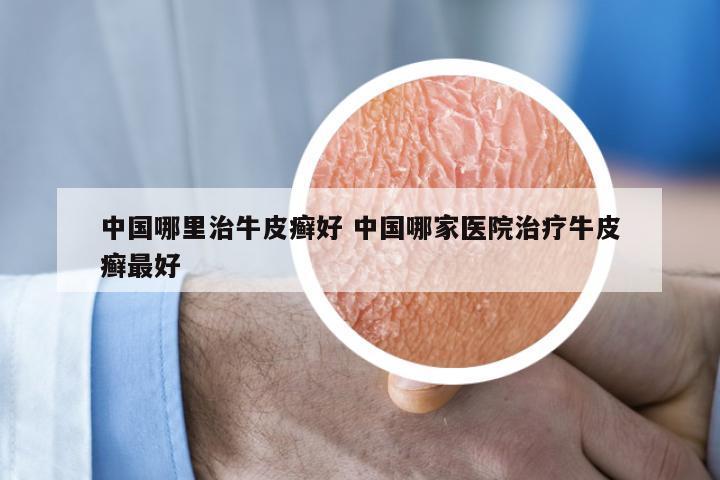 中国哪里治牛皮癣好 中国哪家医院治疗牛皮癣最好