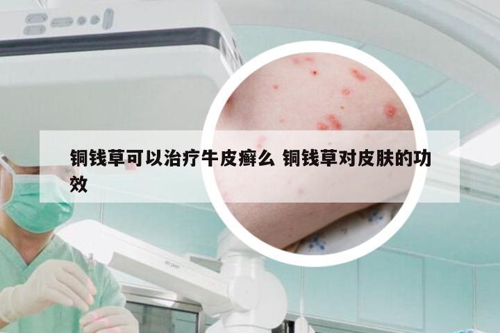 铜钱草可以治疗牛皮癣么 铜钱草对皮肤的功效