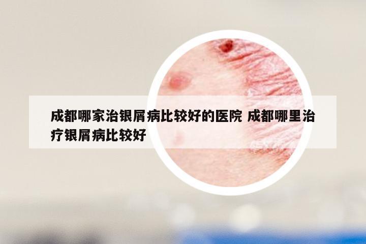 成都哪家治银屑病比较好的医院 成都哪里治疗银屑病比较好