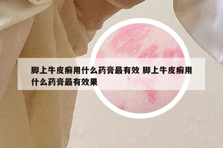 脚上牛皮癣用什么药膏最有效 脚上牛皮癣用什么药膏最有效果