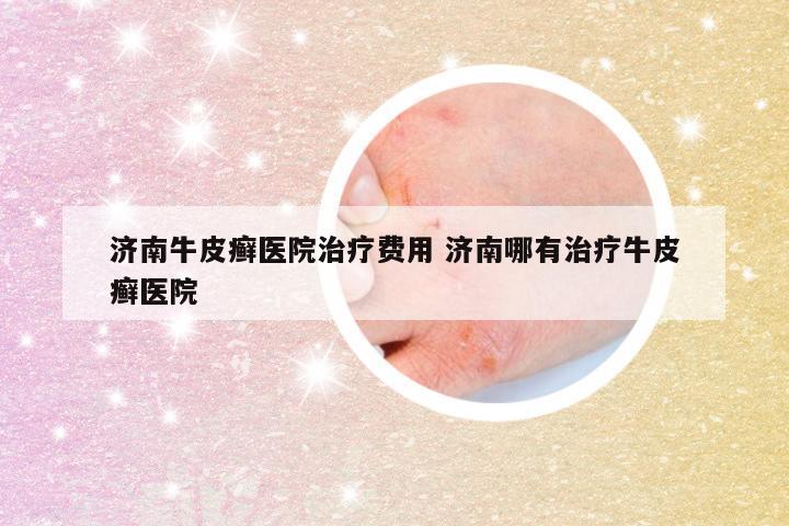 济南牛皮癣医院治疗费用 济南哪有治疗牛皮癣医院
