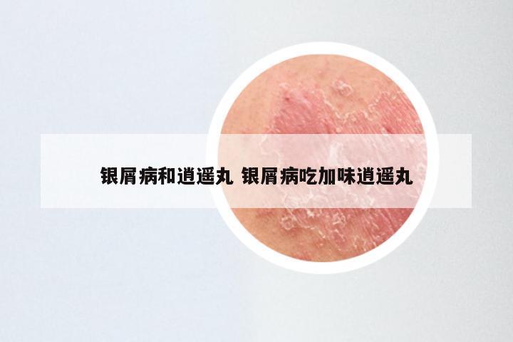 银屑病和逍遥丸 银屑病吃加味逍遥丸