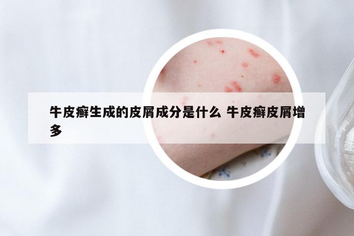 牛皮癣生成的皮屑成分是什么 牛皮癣皮屑增多