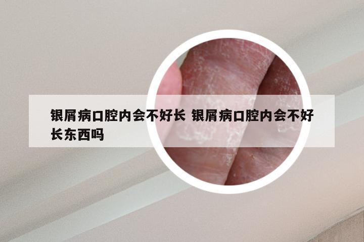 银屑病口腔内会不好长 银屑病口腔内会不好长东西吗