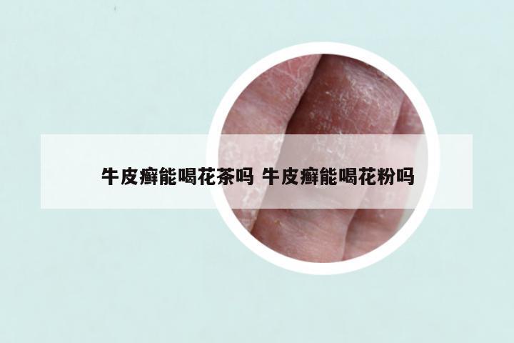 牛皮癣能喝花茶吗 牛皮癣能喝花粉吗