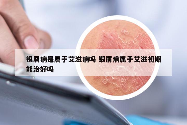 银屑病是属于艾滋病吗 银屑病属于艾滋初期能治好吗