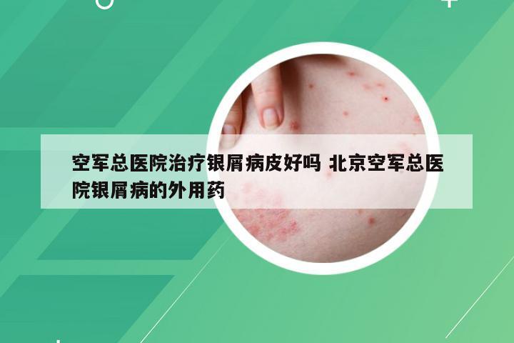 空军总医院治疗银屑病皮好吗 北京空军总医院银屑病的外用药