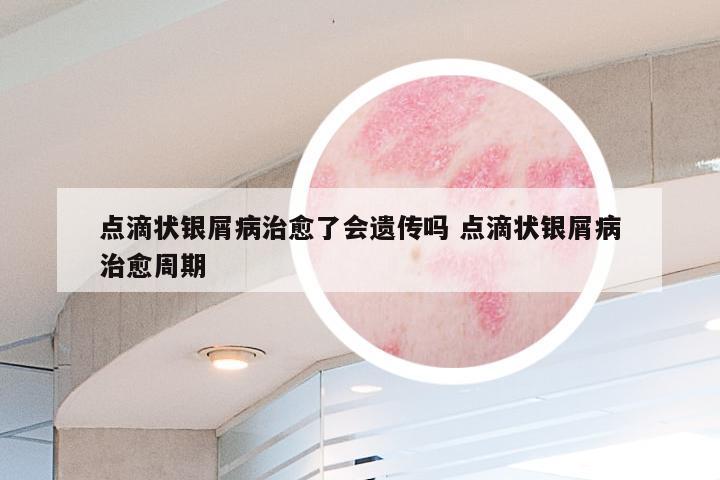 点滴状银屑病治愈了会遗传吗 点滴状银屑病治愈周期