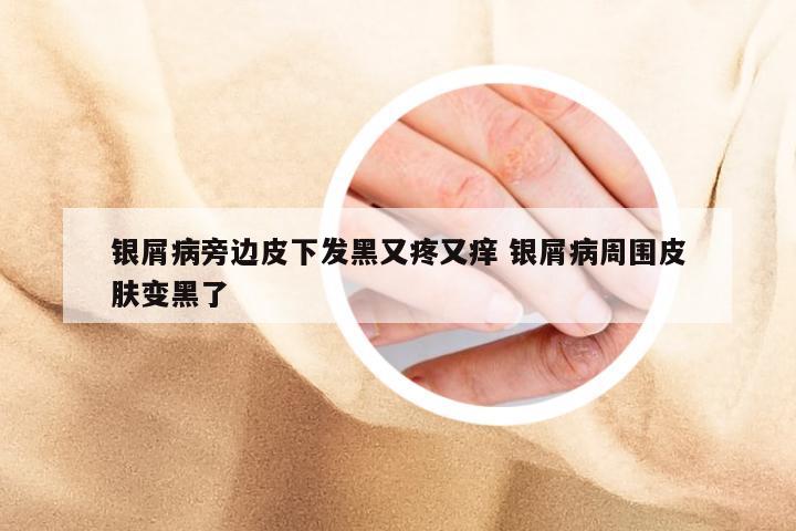 银屑病旁边皮下发黑又疼又痒 银屑病周围皮肤变黑了