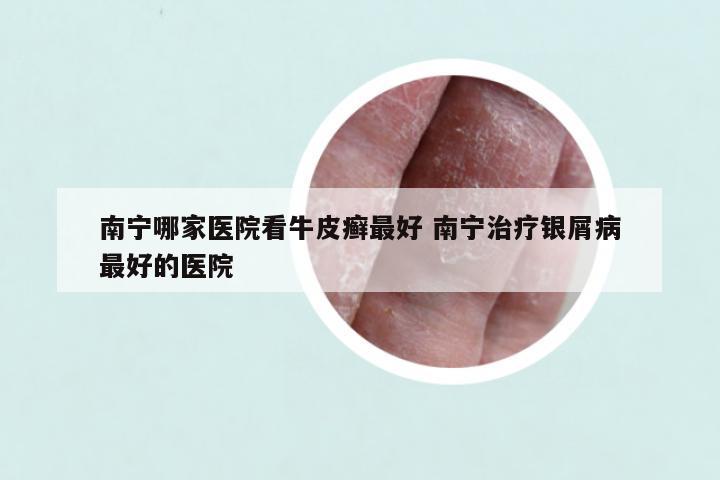 南宁哪家医院看牛皮癣最好 南宁治疗银屑病最好的医院