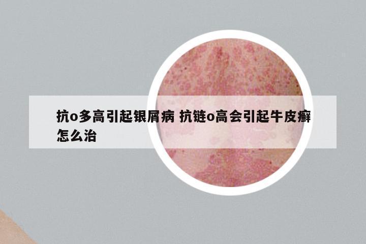 抗o多高引起银屑病 抗链o高会引起牛皮癣怎么治