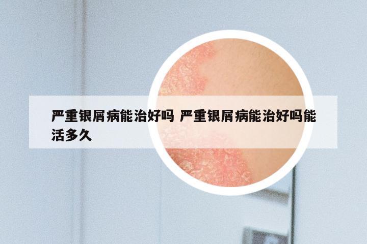 严重银屑病能治好吗 严重银屑病能治好吗能活多久