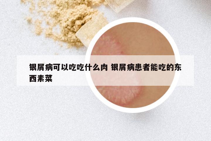 银屑病可以吃吃什么肉 银屑病患者能吃的东西素菜