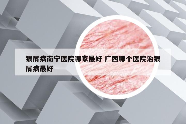 银屑病南宁医院哪家最好 广西哪个医院治银屑病最好