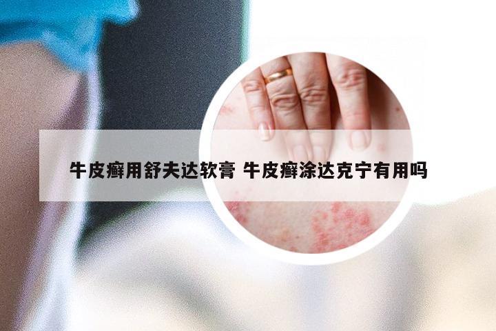 牛皮癣用舒夫达软膏 牛皮癣涂达克宁有用吗